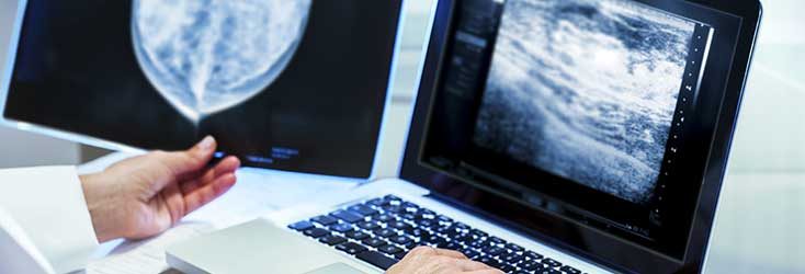 IBM e Sage Bionetworks anunciam os vencedores do desafio de algoritmos sobre mamografia