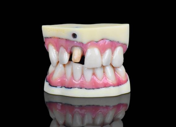 Odontologia: Novo modelo agiliza produção de modelo 3D