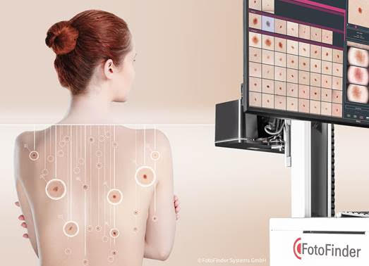 FotoFinder apresenta a próxima geração de sistemas para a detecção precoce do câncer de pele